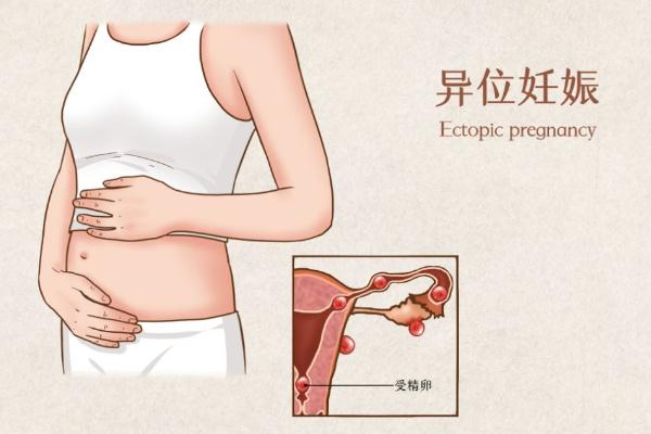 宮外孕的癥狀有哪些表現 宮外孕怎么辦處理方法